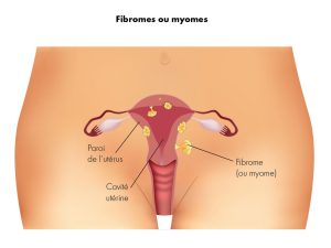 Fibromes