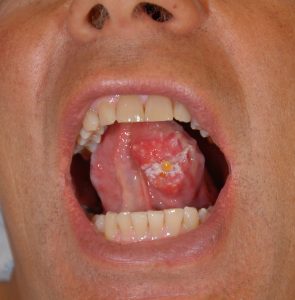 Cancers de la bouche