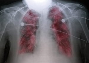 OEdeme-pulmonaire